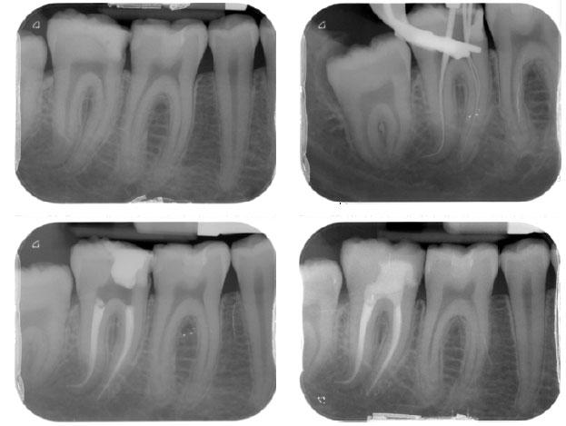 снимок зубов при лечении каналов 